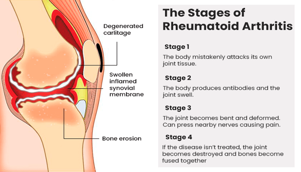 Combination Therapy for Rheumatoid Arthritis