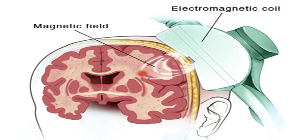 Repetitive Transcranial Magnetic Stimulation (rTMS): What You Should Know