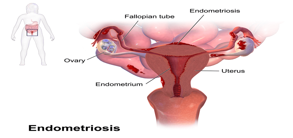 Linking Fusobacterium to Endometriosis: What You Should Know