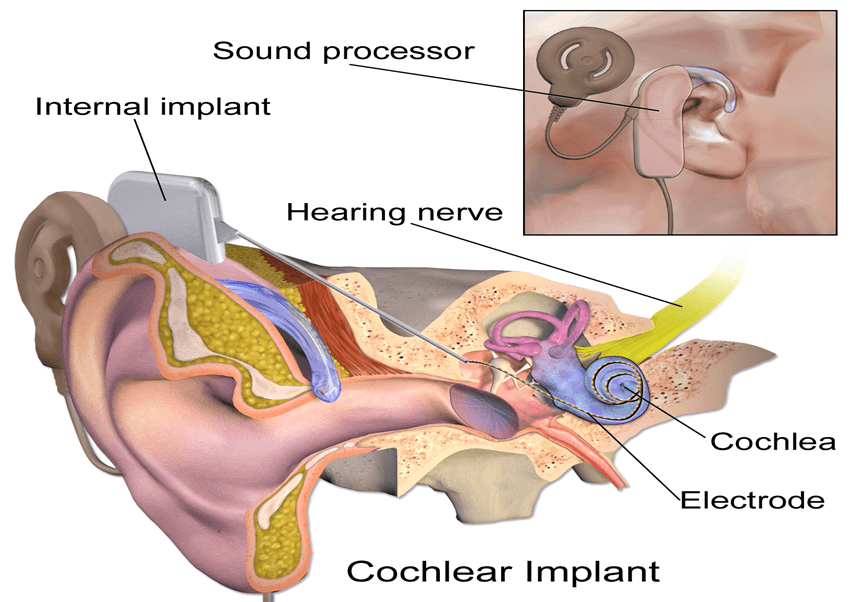 Transforming Lives: Cochlear Implants in India: What You Should Know