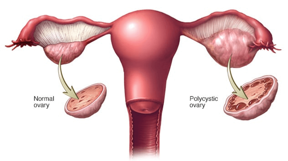 PCOS Awareness and Management in India: What  You Should Know