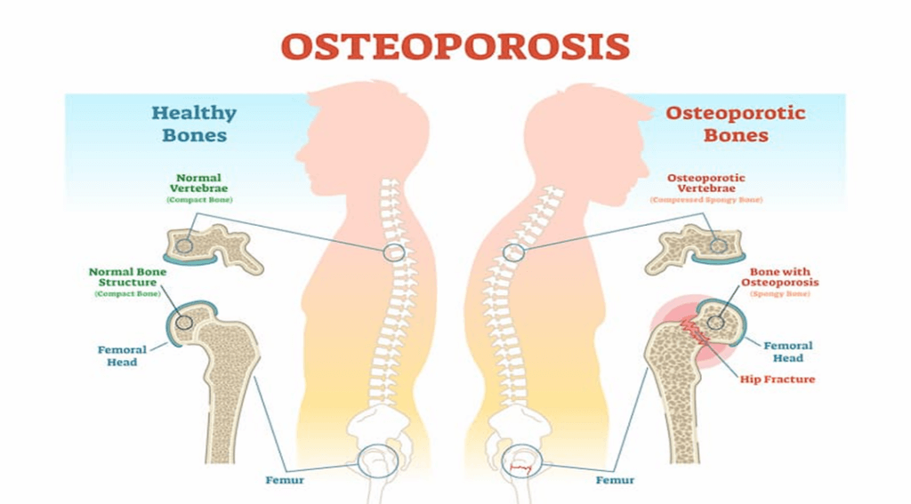 Silent Epidemic: Osteoporosis Challenges in India: What You Should Know