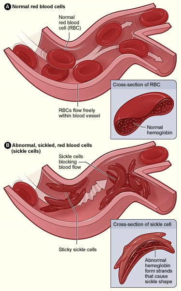 Casgevy Gene Therapy: What You Should Know